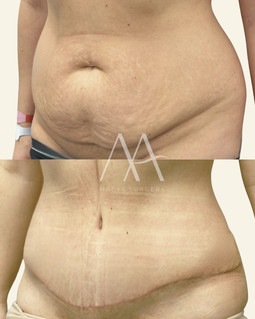 Tummy Tuck