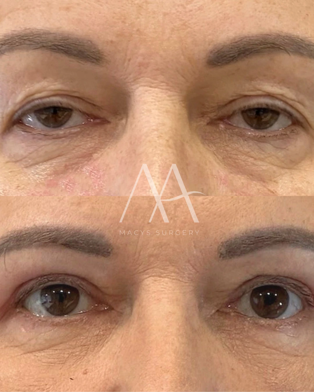 Upper Blepharoplasty