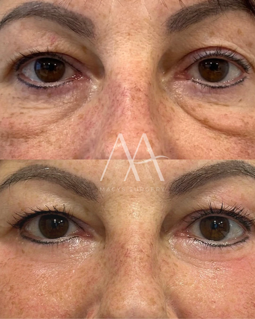 Upper and lower blepharoplasty