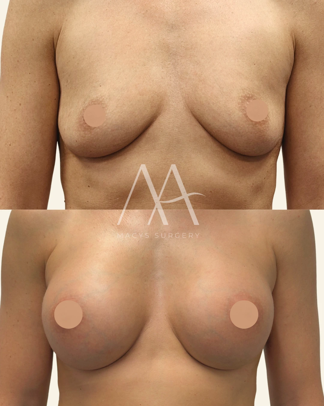 Breast Augmentation