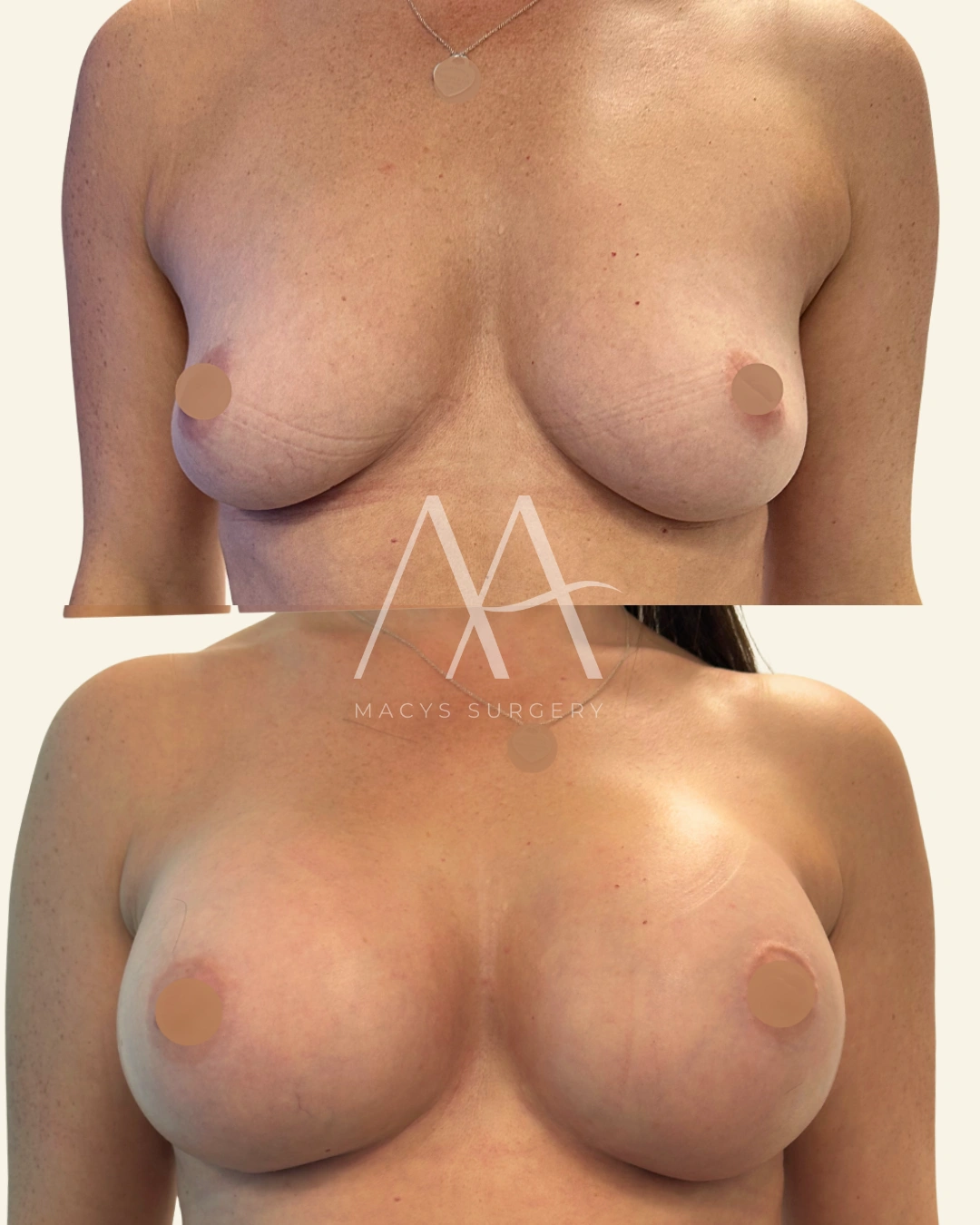 Breast Augmentation