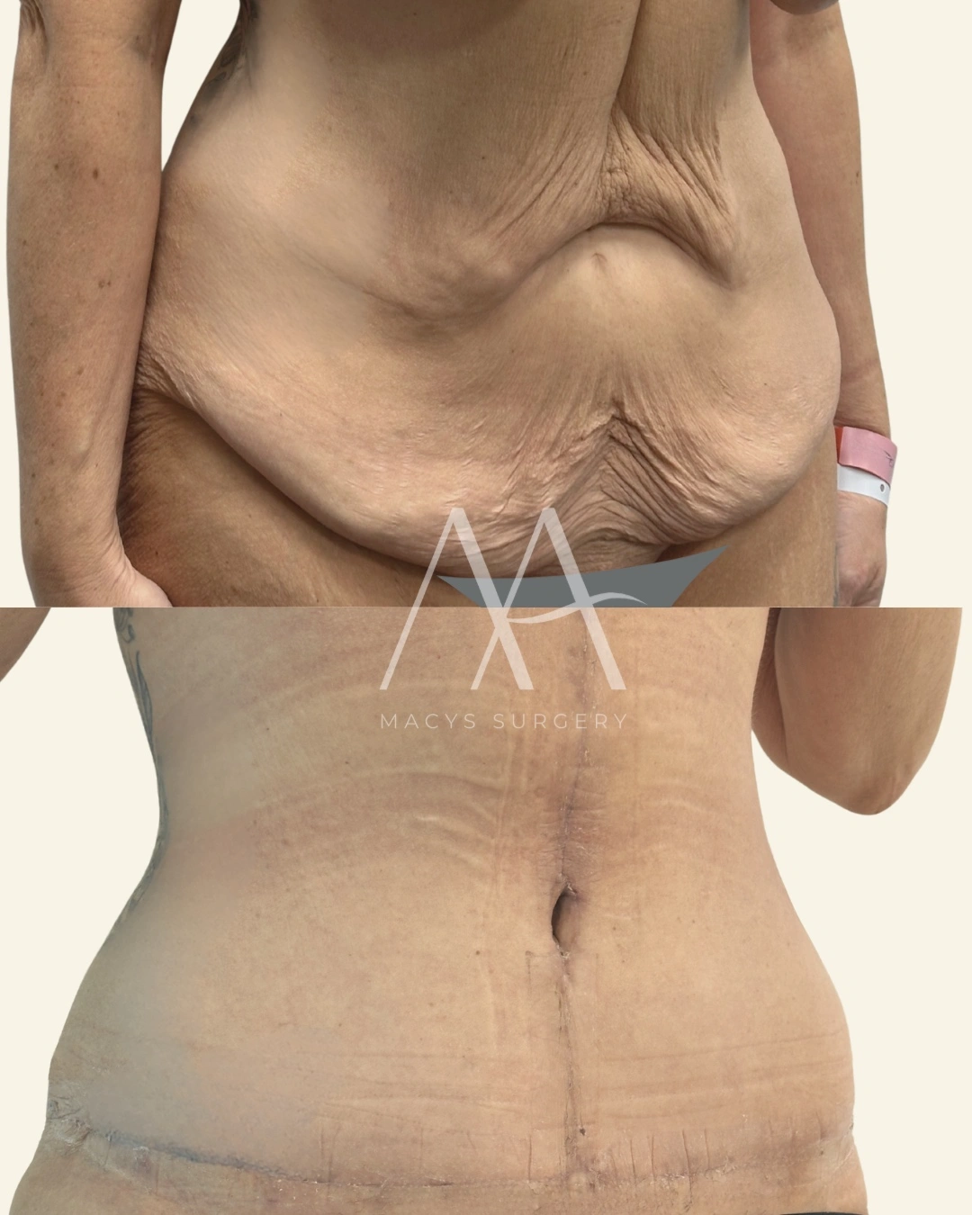 Tummy Tuck
