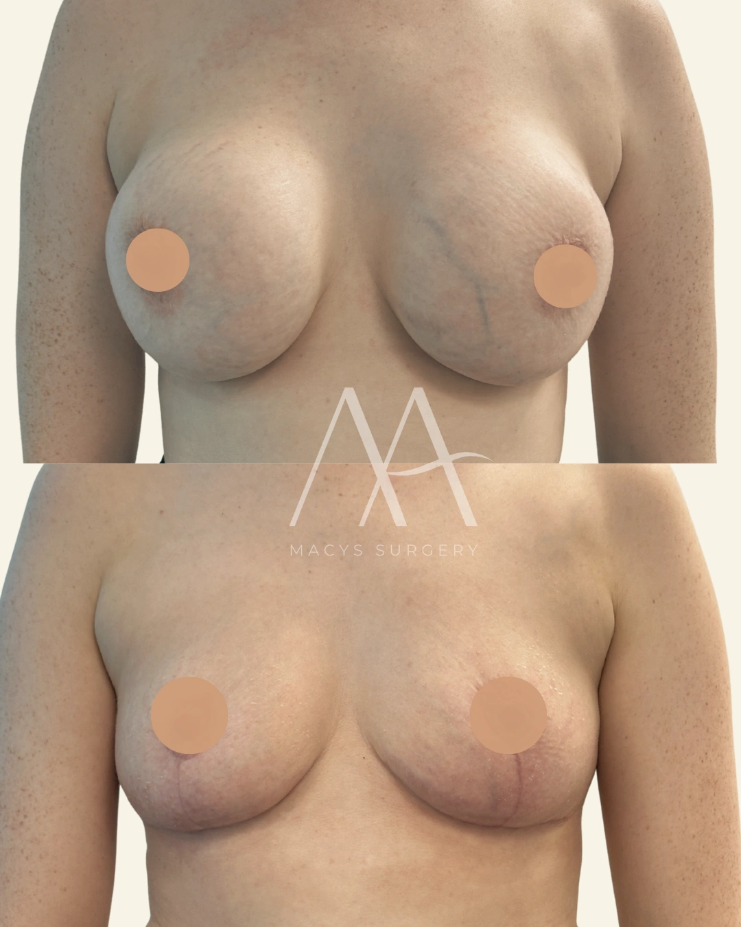 Implant removal