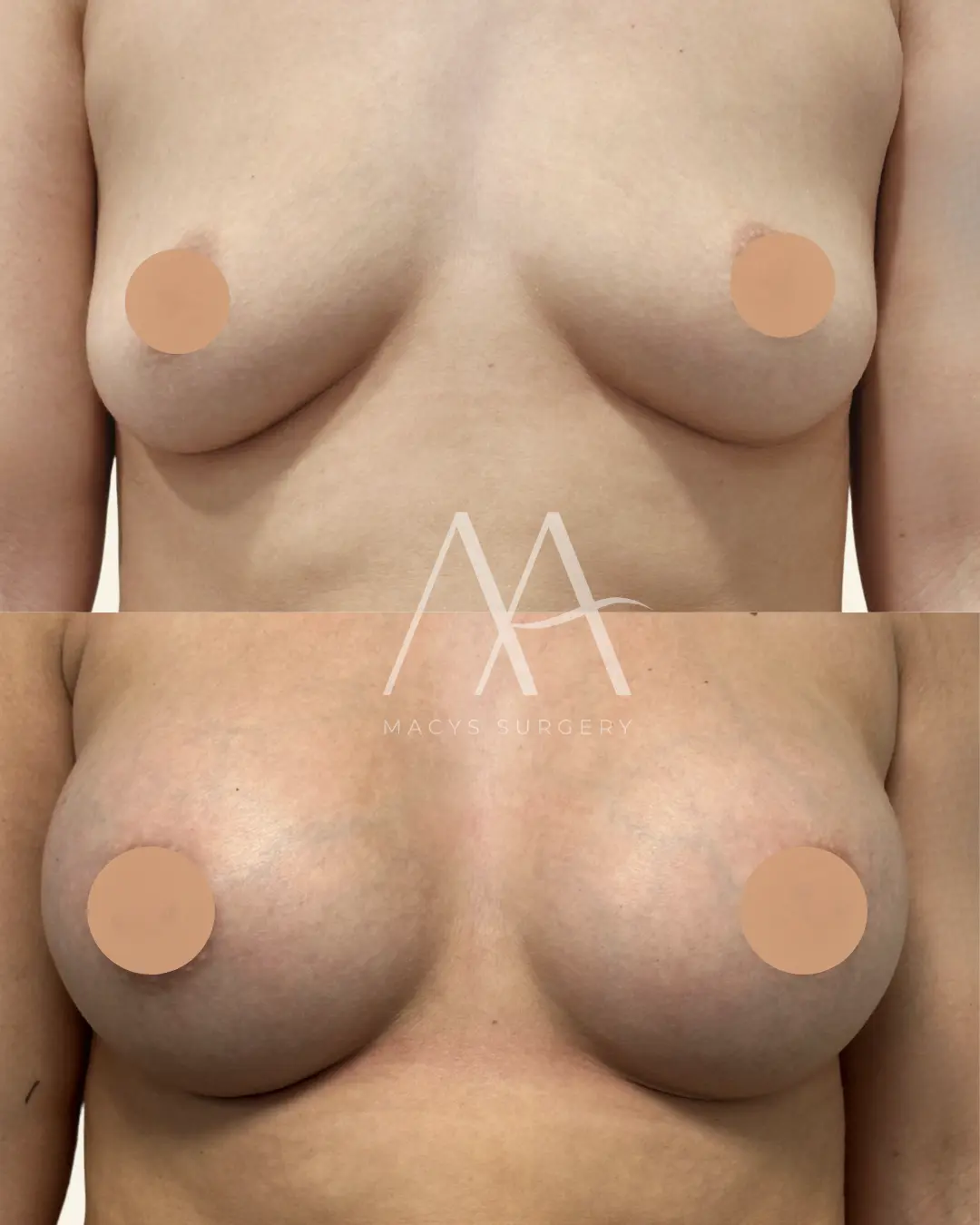 Breast Augmentation