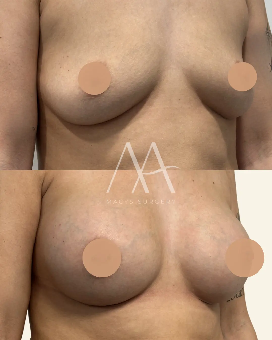 implant change (5)