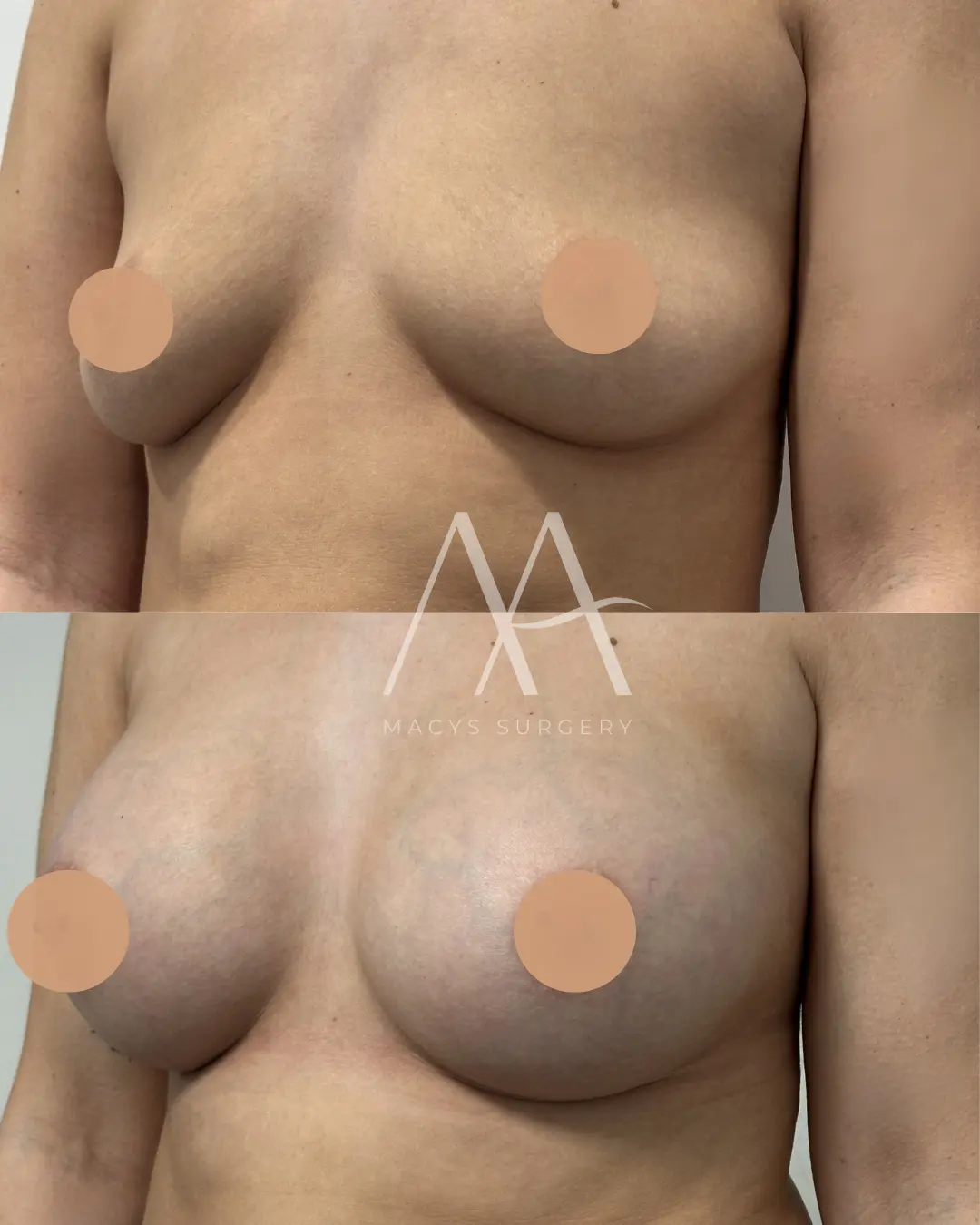 implant change (6)