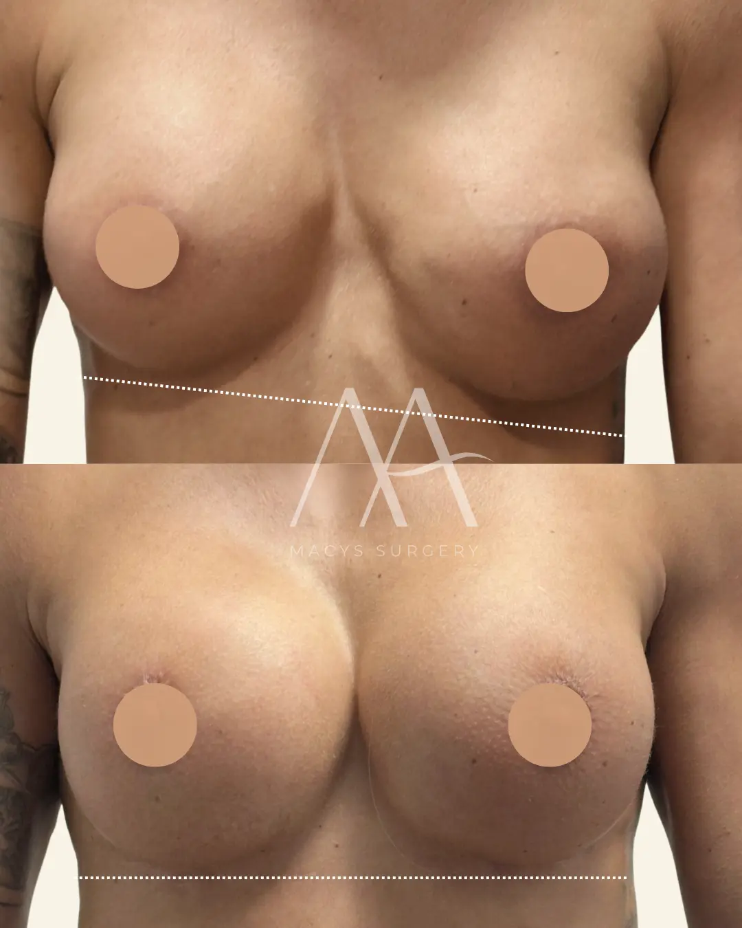 re-augmentation