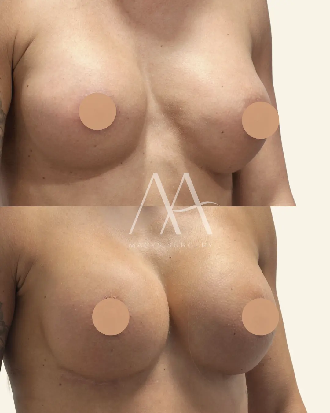 Re-augmentation