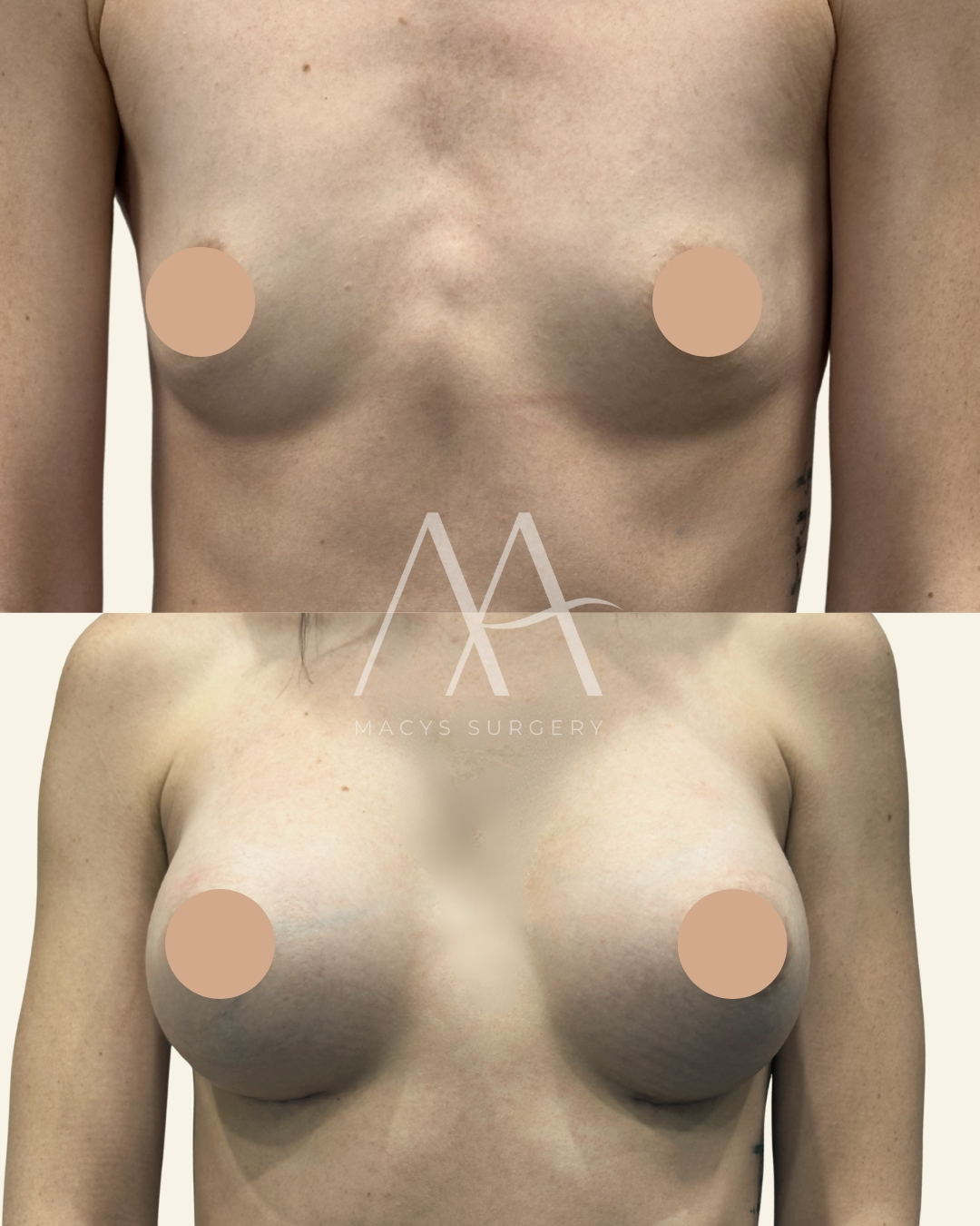 Breast Augmentation by Dr Macys