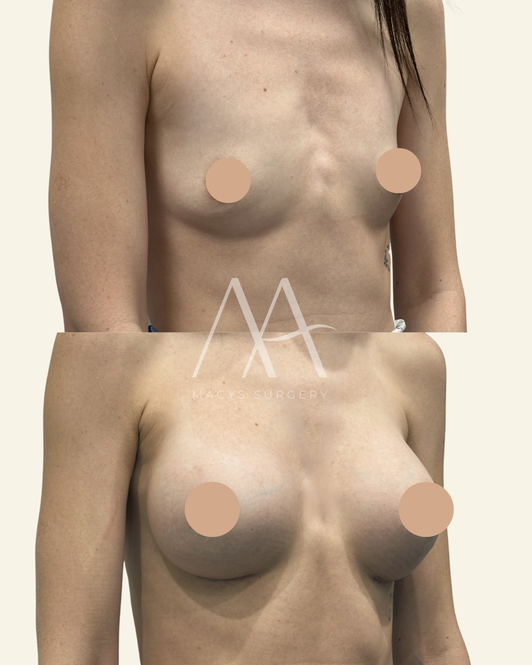Breast Augmentation by Dr Macys