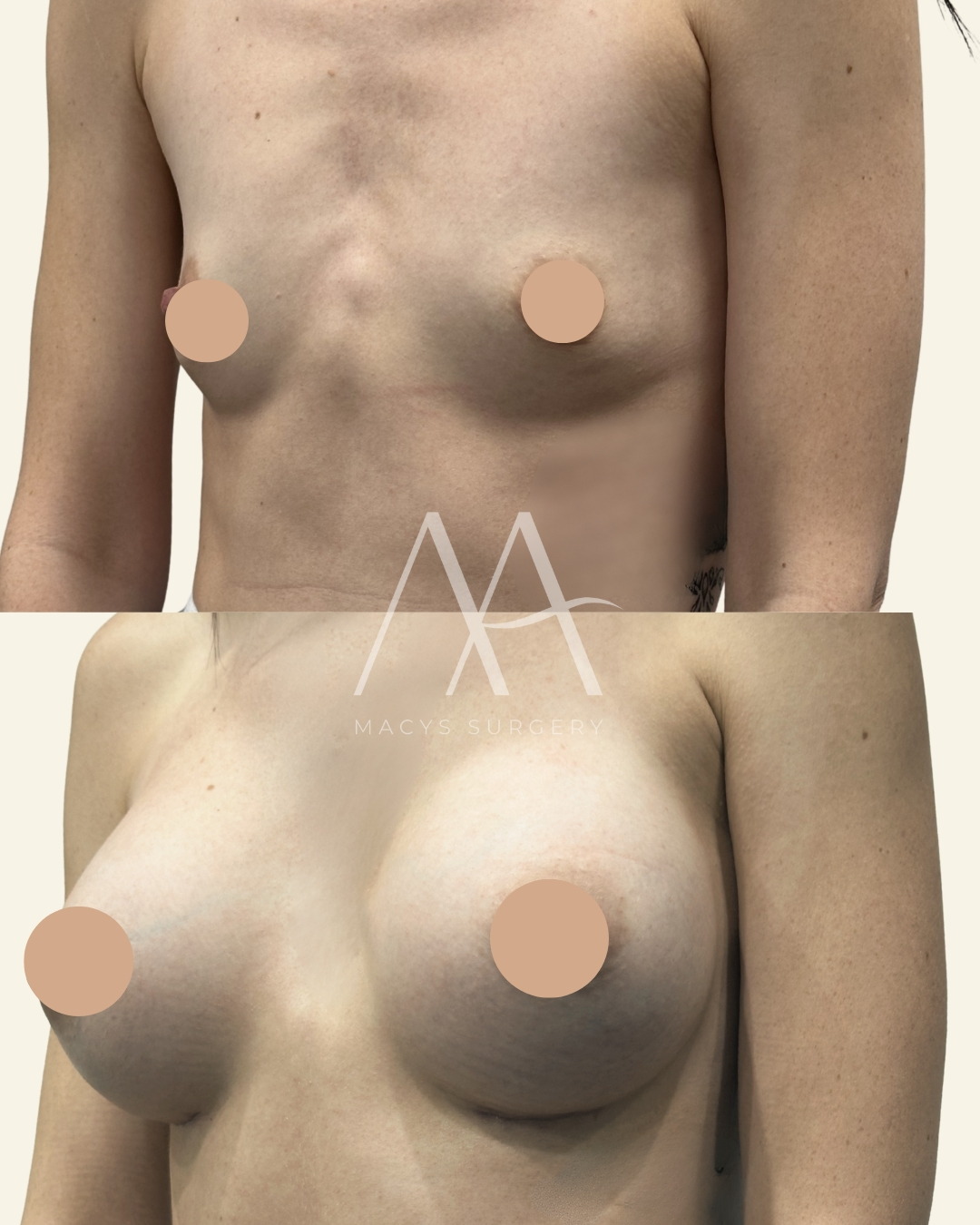 Breast Augmentation by Dr Macys