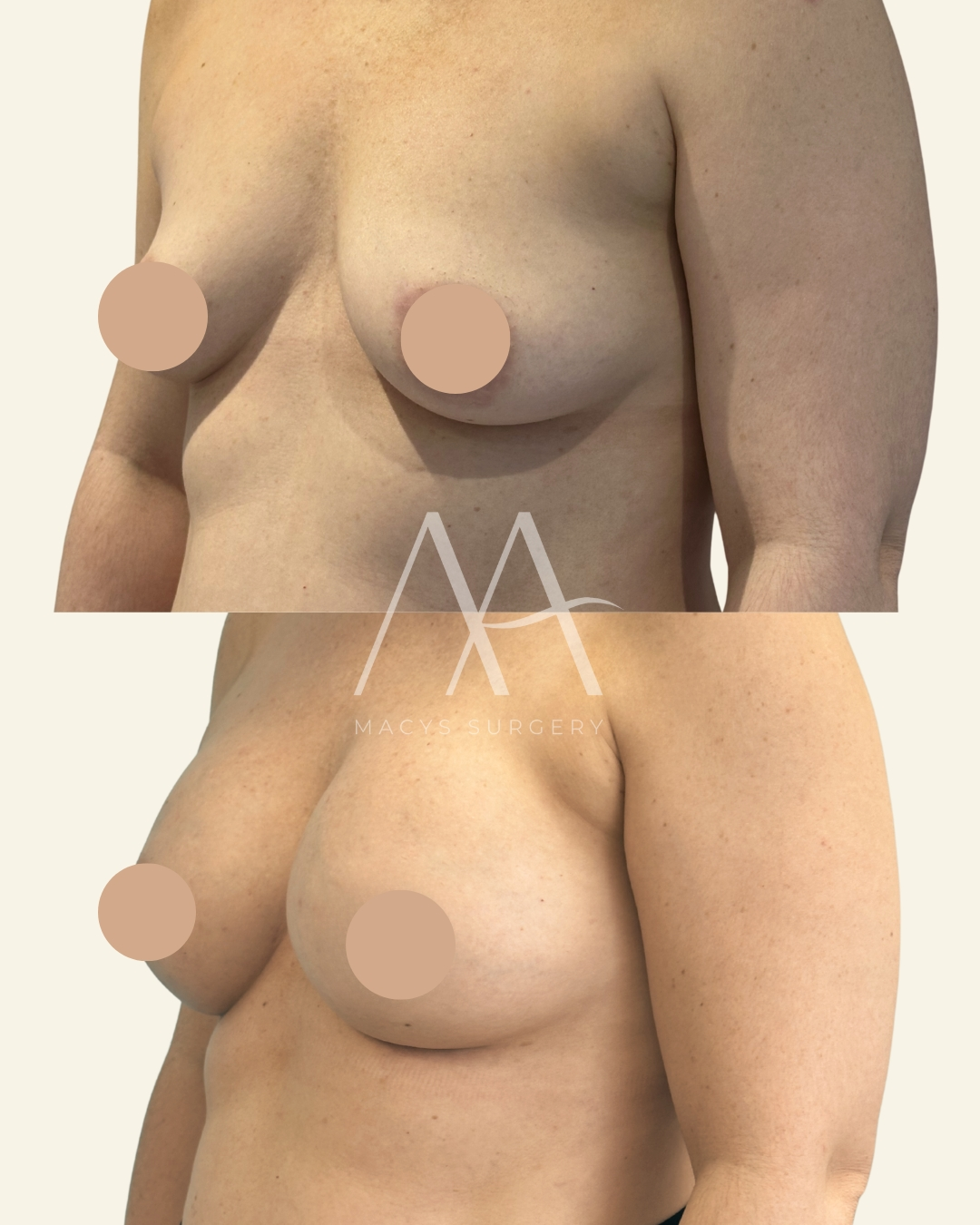 implant change (3)