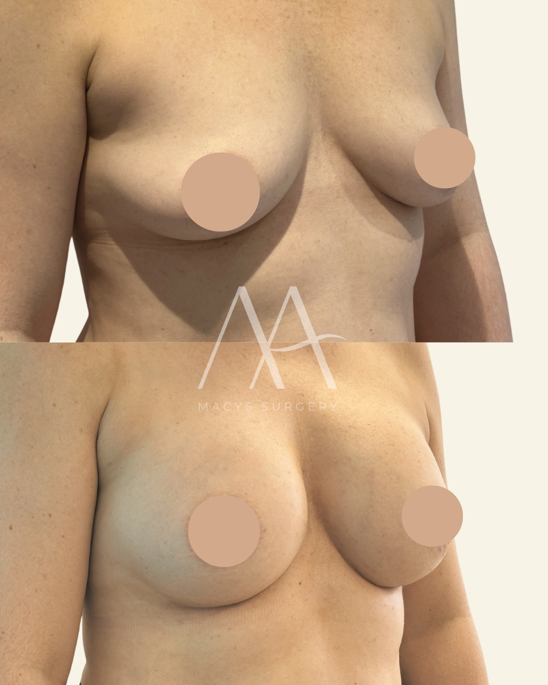 implant change (4)