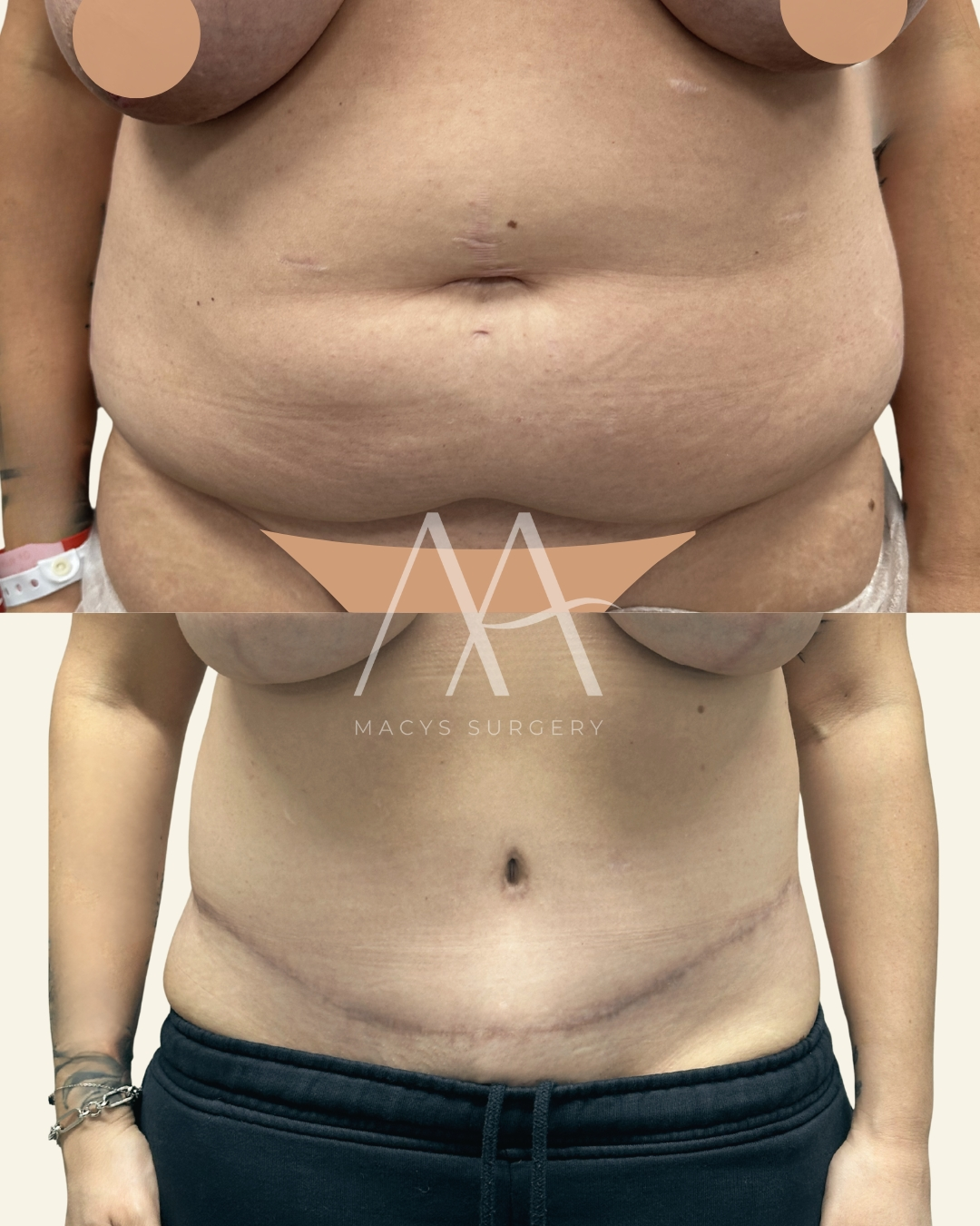 implant change (5)