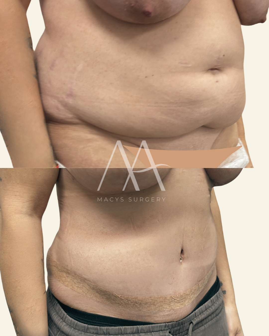 implant change (6)